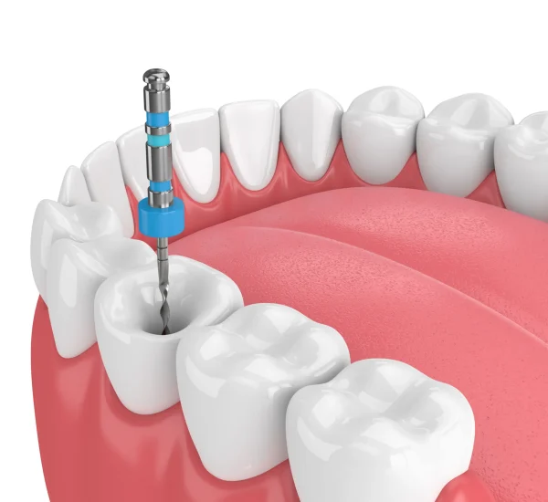 Make-a-Smile-Root-Canal